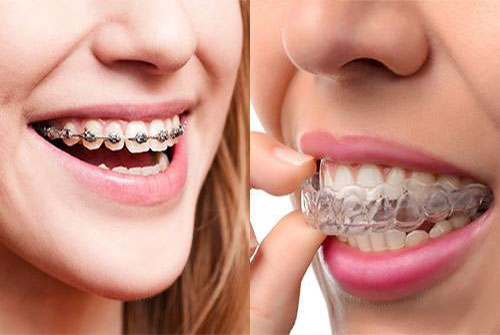 ORTHODONTIE DE L'ADULTE : TECHNIQUE PAR ALIGNEURS (GOUTTIÈRES